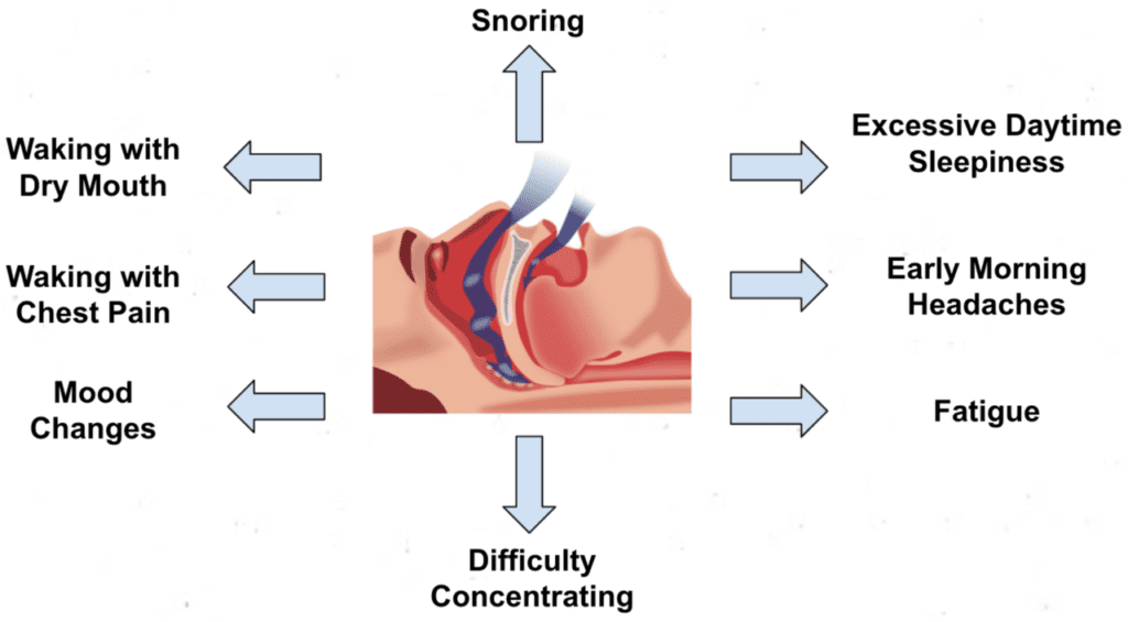 Sleep Apnea Treatment In Bangladesh